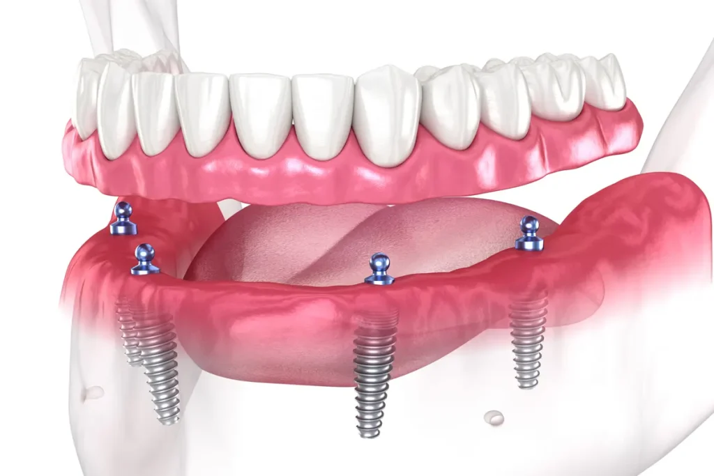 Dental Implant – Smizel